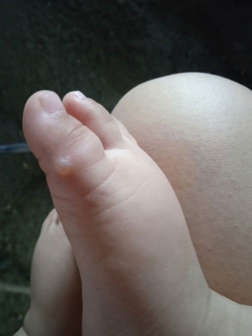 Bulutong or kinagat ng insect??