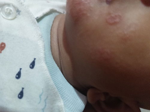 Bintik merah di wajah bayi