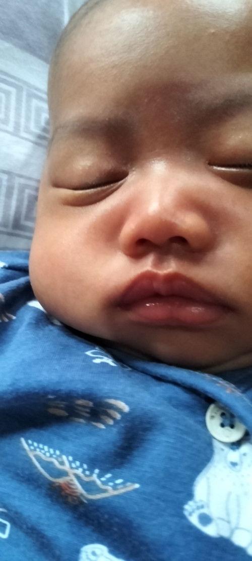 Bibir anak asimetris