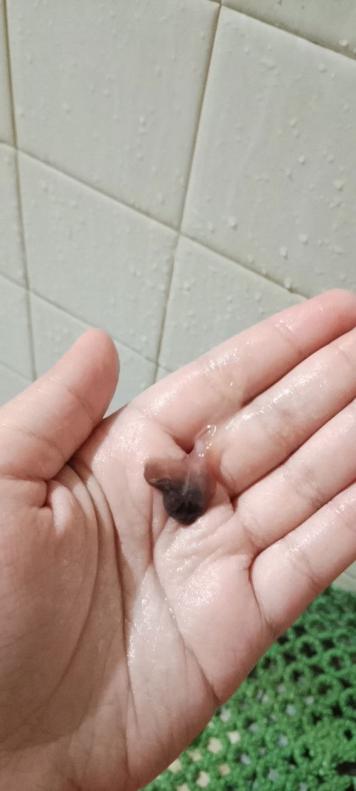 13/9/25 keluar ketulan bulat besar,3/10/25 dapat tahu mengadung tapi besalin 29/5/26 boleh jelaskan