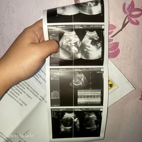 Gender
90% Baby boy daw mga mi, yan din yung picture may lawit sya hehe, sure na kaya yan?