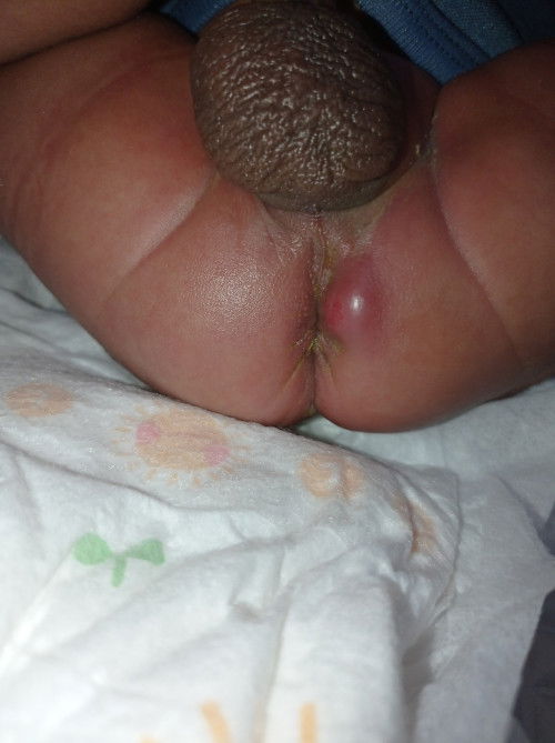 ini kenapa ya? bisul kah 😭😭