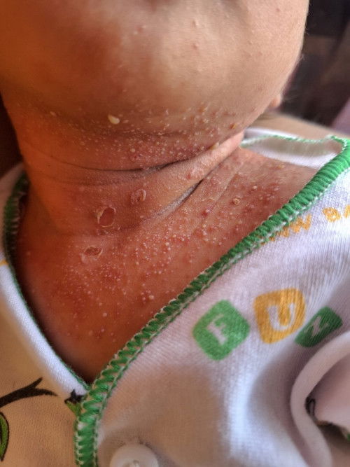 Iritasi kulit newborn