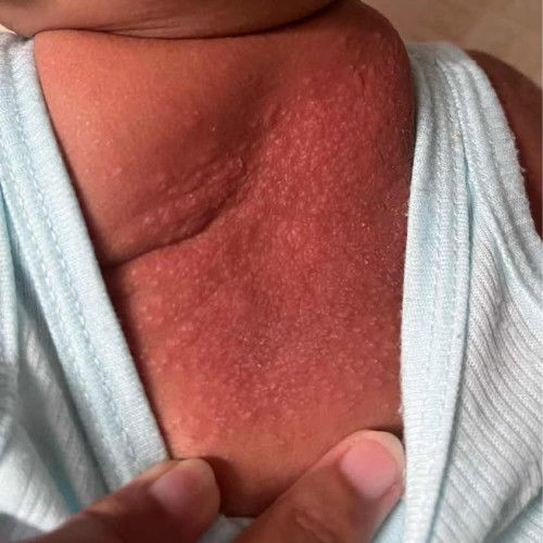 Punggung bruntusan merah