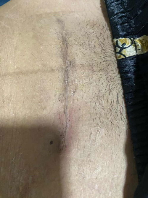 แผลผ่าแบบนี้ปกติไหมคะ