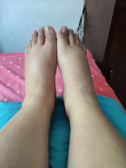 Kaki bengakak setelah lahiran SC