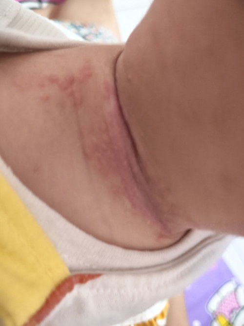 Merah di leher dan ruam popok