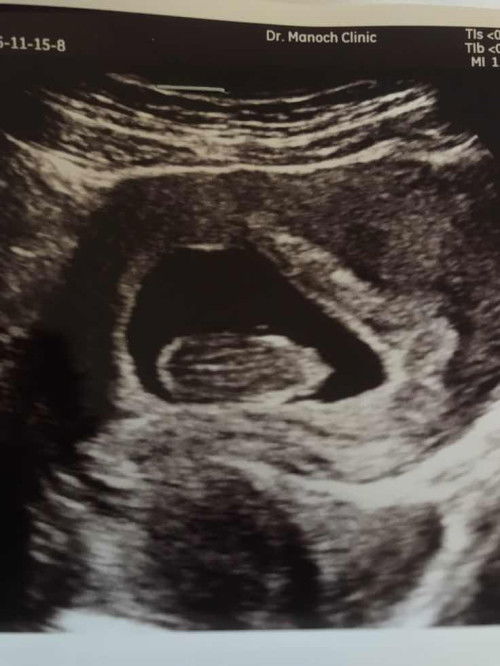 ตั้งครรภ์ได้10week