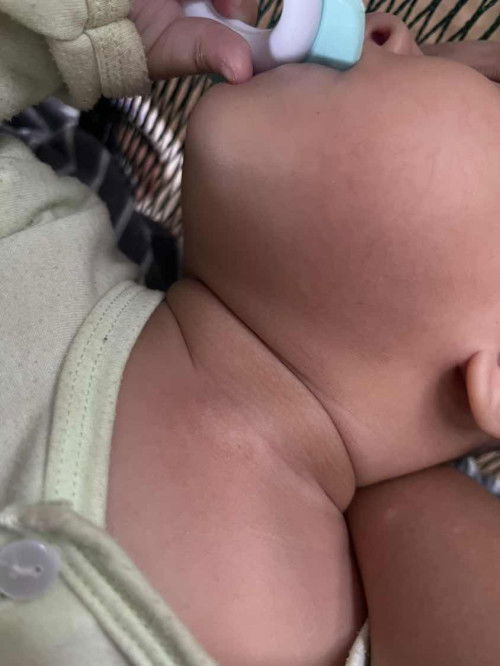 ขอคำแนะนำ ผื่นน่อยค่ะ