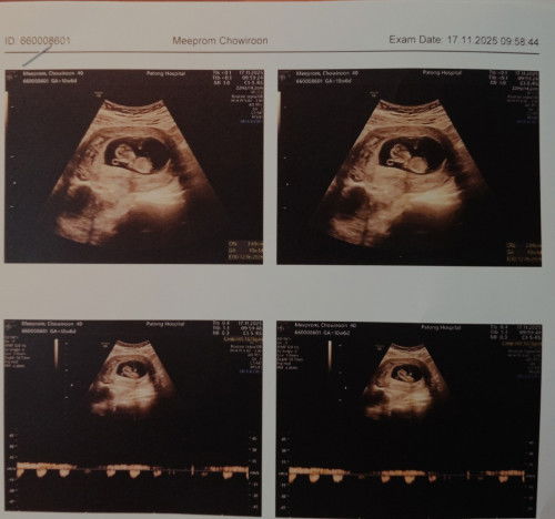 10w6d ได้เห็นน้องแล้วคะดีใจมากเลย น้องแข็งแรงดี หัวใจเต้นปกติ