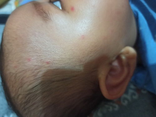 Muncul bintik merah saat demam