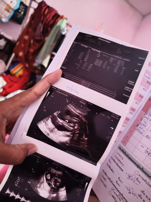 เพศลูก20+5วีค