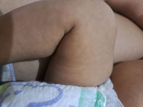 Bun anakku usianya 24 hari kenapa ya sebadan warna kulitnya seperti ini tidak merata. Ini bukan panu