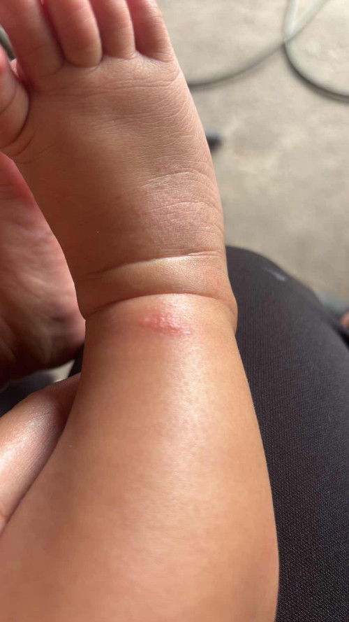 Gatal kering kemerahan