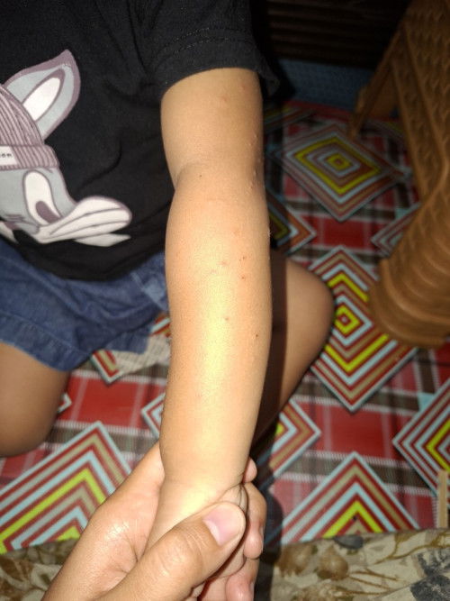 Ini ruam alergi atau bukan ya
Anak 2 tahu