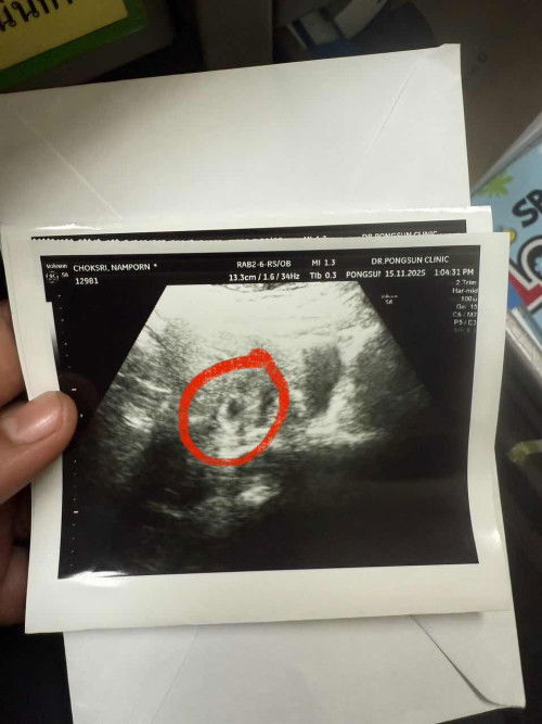 ใช่ถุงตั้งไหมคะ อายุครรภ์ 4 W