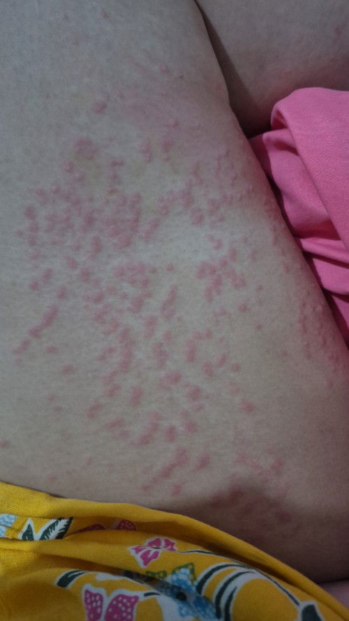 Yg jijik mending SKIP!!!