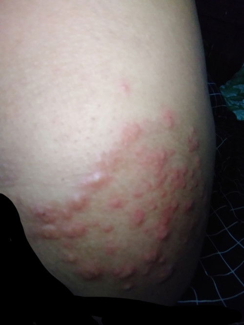 Gatal di area paha atas