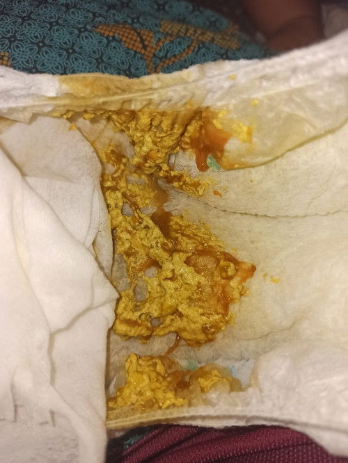 Normal ke ye baby 5 bulan popoo mcm ni?? Baby fully fm.. sian tengok, nak tidur pon berak..