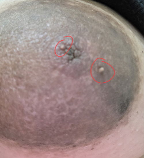 Skin tags / Warts, necessary po ba na ipatanggal?