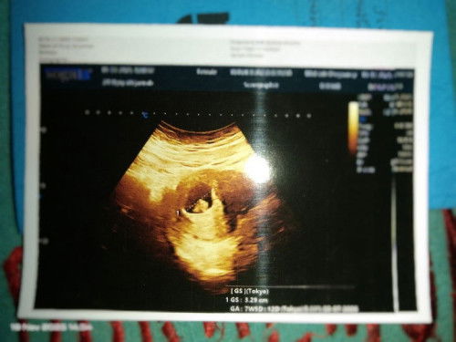Hamil 7 minggu