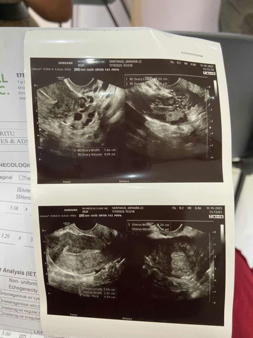 2 months delay pcos poba ito? ask lang po