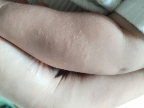 Kulit baby ada timbul Biji2 kecil