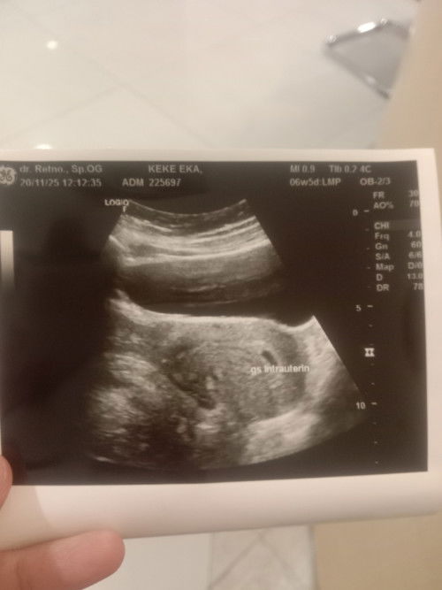 Hasil USG hamil 6 mg
