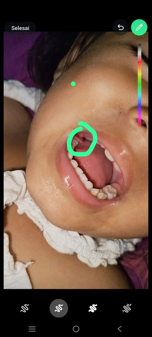 Gusi anak mau ngelupas