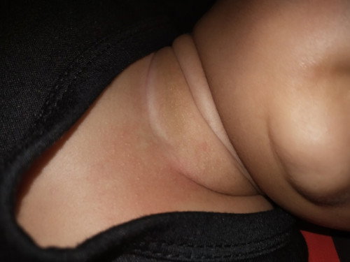 Bagusnya pake apa yah biar cepet sembuh