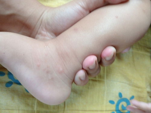 bun, mau tanya dong. anaknya ada yg pernah bintik bintik kecil berair? bisa sembuh dikasih apa ya?