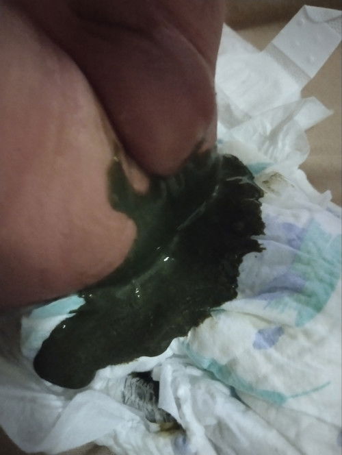 Bayi 1bulan feses ya seperti ini bahaya gak ya bun. Jadi kepikiran