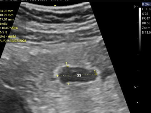 อัลตราซาวตอน7w5d ยังไม่เห็นตัวน้องเลยค่ะ