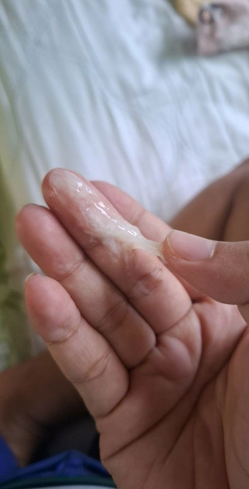 ท้อง32+1วันมีแบบนี้ออกมาคะใช่มูกไหม