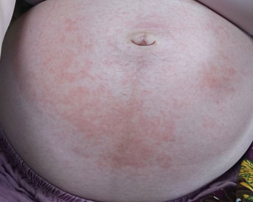 Bintik2 merah pada perut