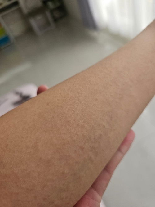 Bintik bintik merah di tangan dan kaki