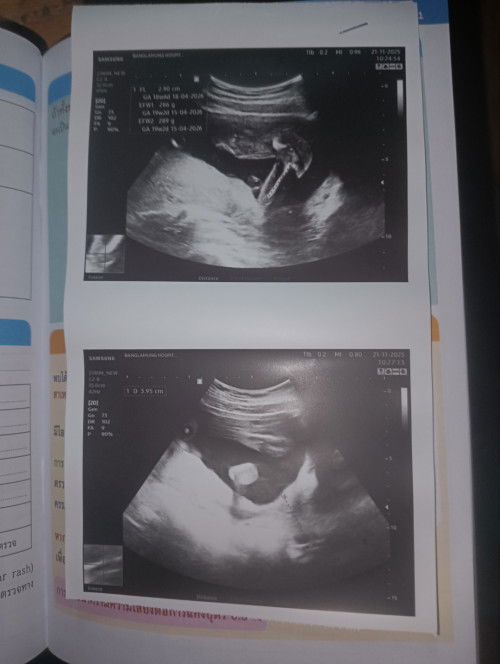 อัลตร้าซาวด์