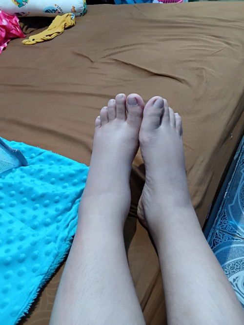 Kaki bengkak pasca SC