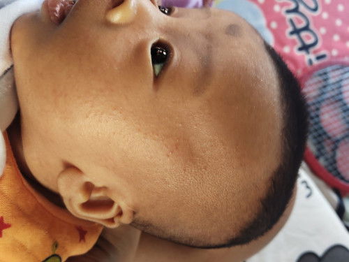 ขอสอบถามผดผื่น