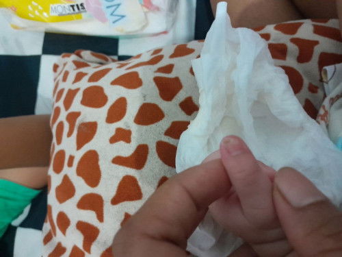 ada yg tau cara ngatasi jari bayi bengkak karna potong kuku kependekan , bayi ku bru 42 hari
