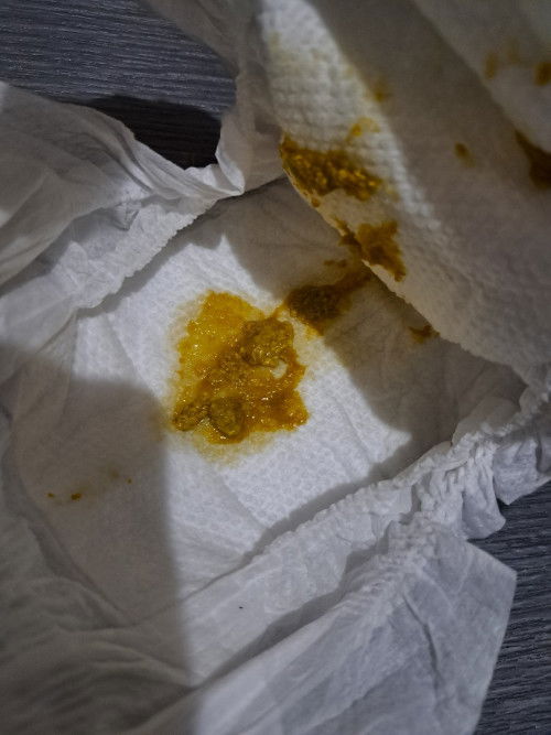 Poop ni 5 months old, Normal po ba ito?