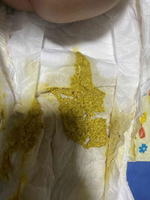 ขอถามเกี่ยวกับอึลูกหน่อยค่ะแม่ๆ