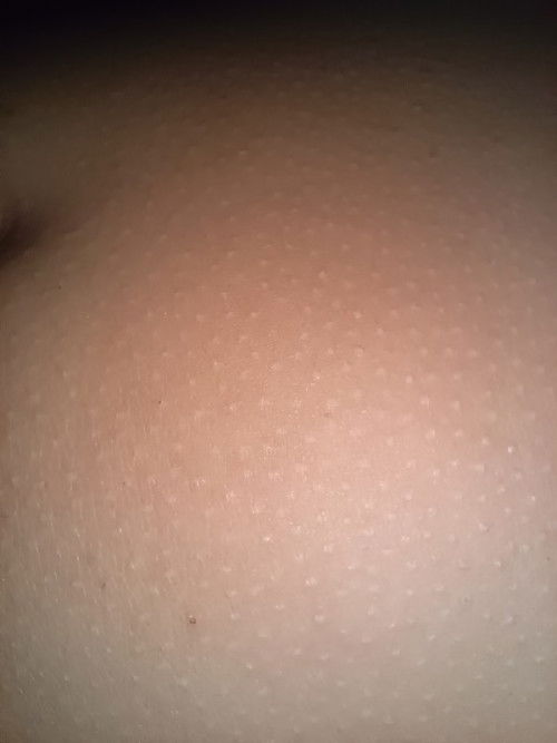 2 ขวบ ผิวที่พุงชอบแห้งสาก และคัน