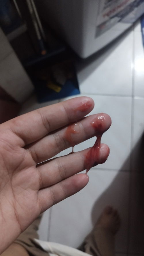 Bloody Mucus Plug