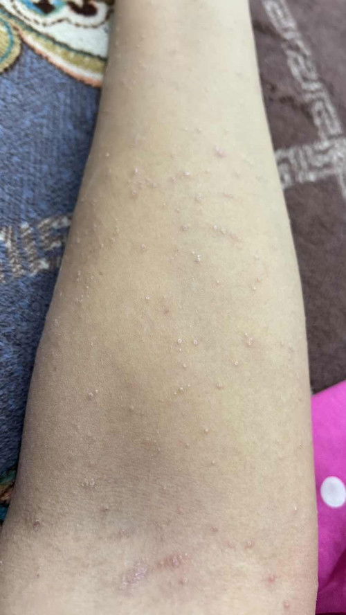 Obat atau salep yg meredakan gatal