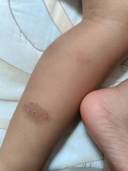 Tolong di bantu jawab ya bunda bunda🙏🙏 *bekas gigitan serangga yang menghitam di kaki anak*