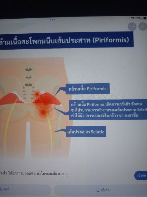 ปวดก้นด้านขวา