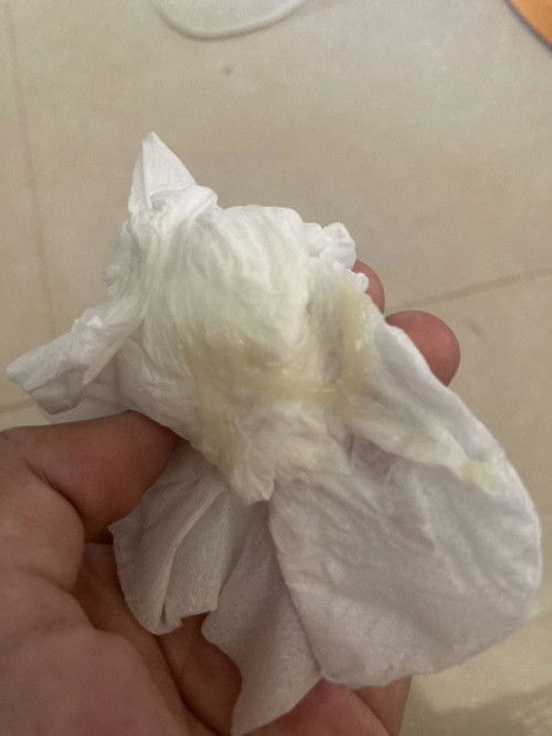 39+1แบบนี้เรียกมูกใสหรือตกขาวคะ