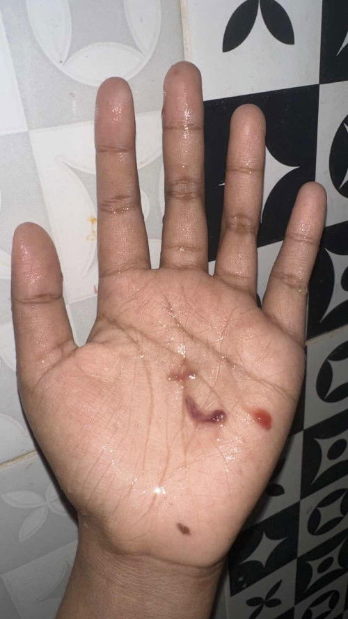 Hb tm 2 keluar darah