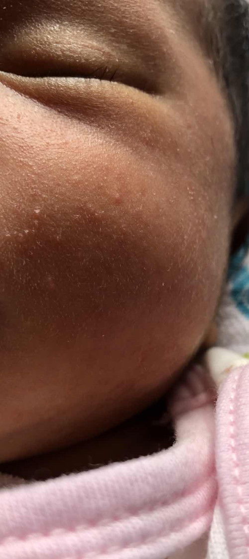 Cara nak hilang kan tiny bumps kat muka newborn. Boleh share tak?